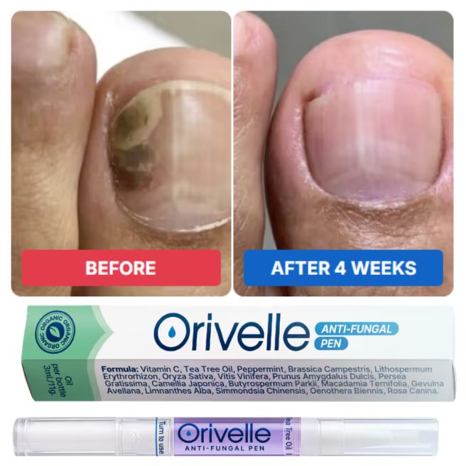 Orivelle nail appearance comparison image