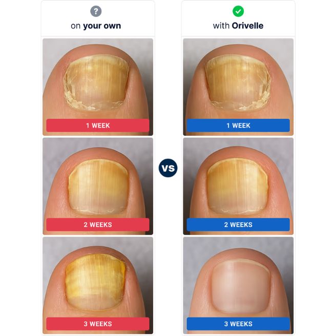 Orivelle nail appearance progression graphic